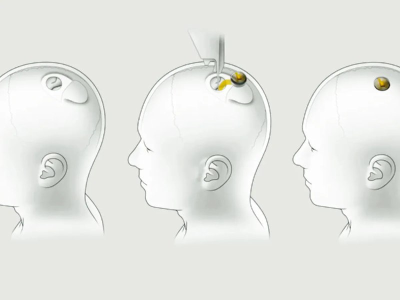 Neuralink имплантирует третий чип в мозг
